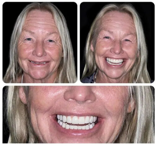 Laozik™ - Advanced Customized Full Denture Set - Image 2