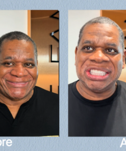 LAOZIK™ – Complete Denture Set