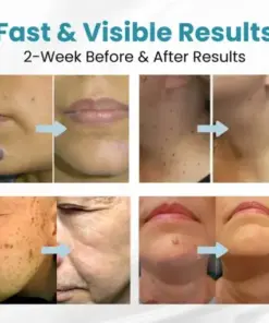 LAOZIK® Non-Invasive Mole and Wart Removal Laser Pen