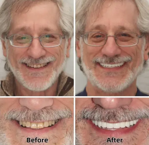 Laozik™-Advanced Custom-Fit Functional Dentures - Image 4