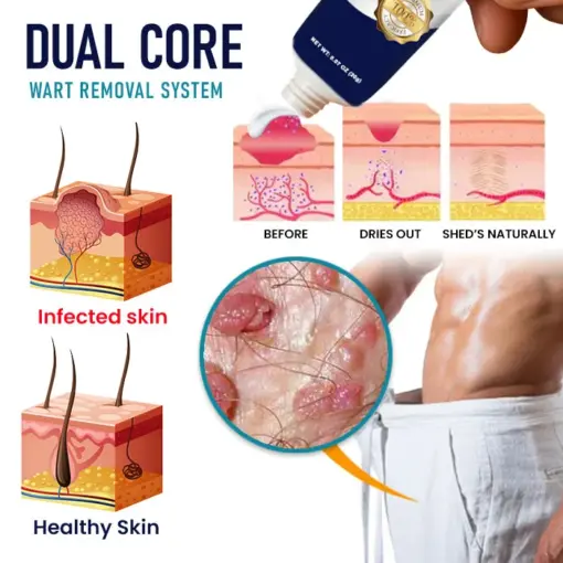 LAOZIK™ Genital Warts Remover Cream - Image 4