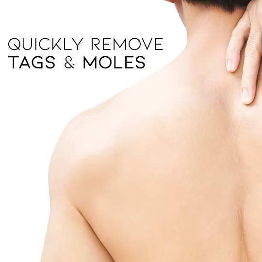 LAOZIK™ WipeOff Tags & Mole Remover - Image 4